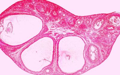 ¿Cómo Superé El Síndrome De Ovario Poliquístico (SOP)?