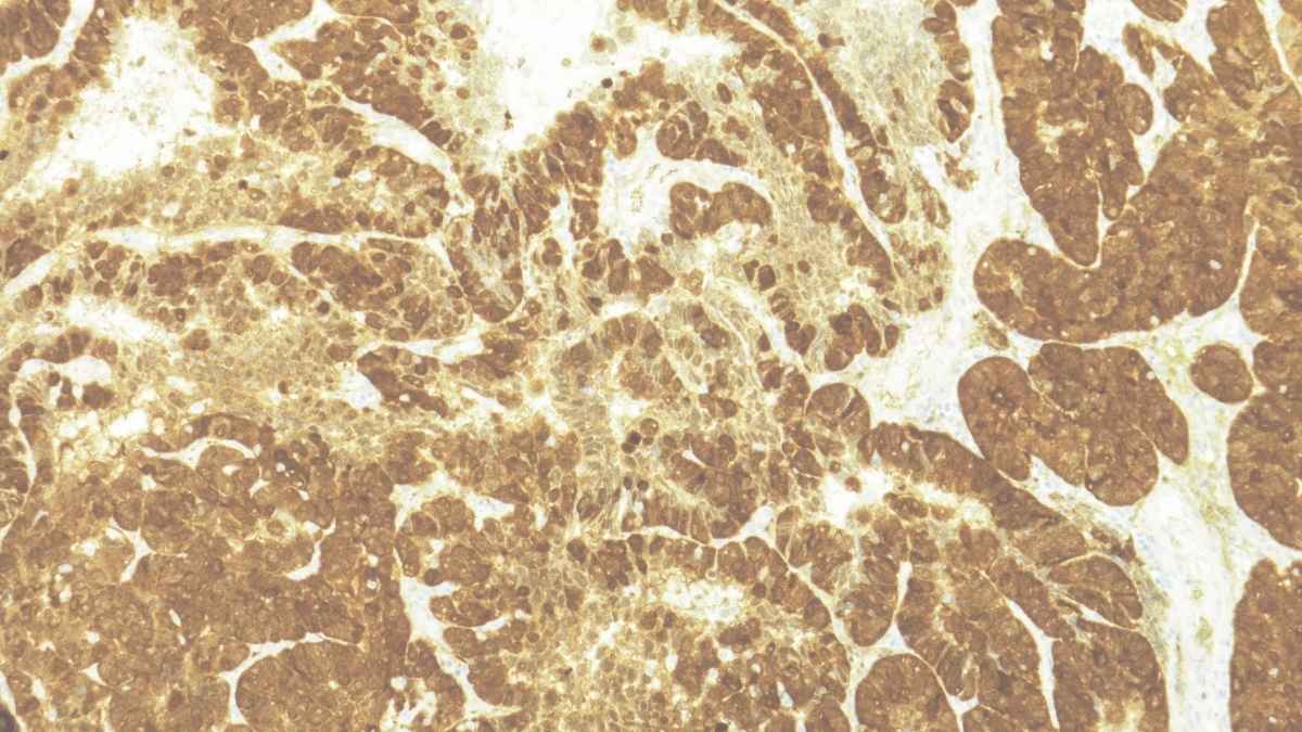 endometriosis